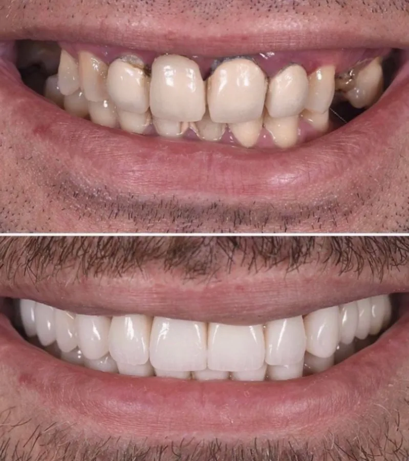 Dental Made Easy - Forest Hills: The Implant-First Checklist for New Patients in Queens